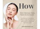 How Can Skin Renew Help Heal Acne Scars in Auckland?