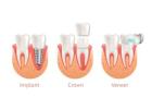 Same-Day Crowns  in Las Vegas at Functional Aesthetic Dentistry