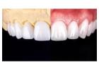 Get your natural look with metal-free Dental crowns in Tijuana from Teeth Savers